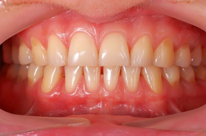 Diş Eti Kanamasının Nedenleri Nelerdir? | Tedavi Yöntemleri
